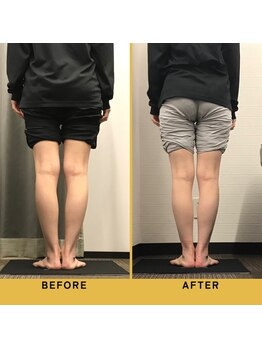ベル/【20代会員様】O脚矯正の変化
