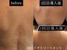 【背中・二の腕ケア】ハーブピーリング3g体験・ニキビや赤いブツブツケア
