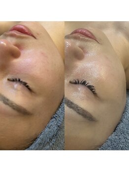 アルム(a'rme)/【くすみ】