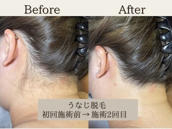 インベスト(INVEST)/うなじ脱毛