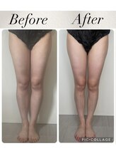 ハーバシー ラボ(herbacie LABO)/かっさ×高周波で美脚へ