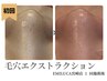 【毛穴エクストラクション】角栓│鼻の毛穴詰まりケア│ごっそりお掃除¥9600