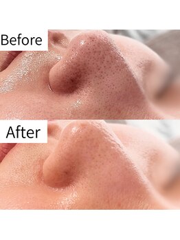 ヒカリエステ 六本木(HIKARI ESTHE)/ハイドラ＋ピーリング＋美容液