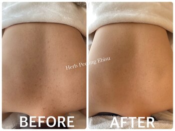 ハーブピーリング 恵比寿/背中ニキビ