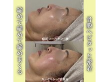 ハニエル(Haniel)/カーボキシー症例