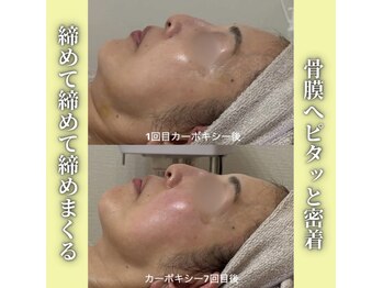 ハニエル(Haniel)/カーボキシー症例