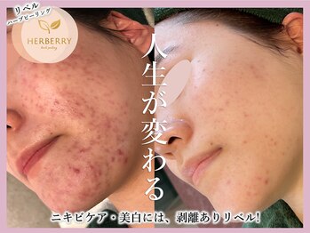 ハーバリー ハーブピーリング 名古屋店(HERBERRYハーブピーリング)/HERBERRYハーブピーリング専門店