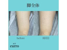 アクト クロ(ACT curro)/【脚全体】脱毛施術例