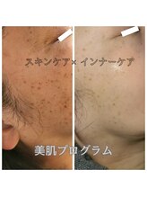 ルオント(LUONTO)/お肌の悩みお任せ下さい♪