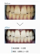 アティロン(Attirant)/【歯のホワイトニング】