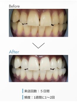 アティロン(Attirant)/【歯のホワイトニング】