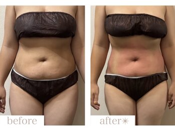 エバーグリーン(Evergreen)/脂肪冷却5回の変化