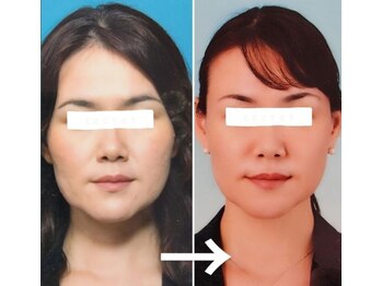 凛コルギ/コルギ継続の変化