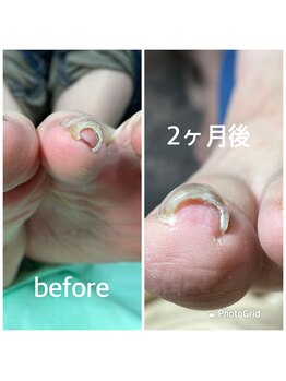 アーク/B/Sブレイス　巻爪緩和ケア