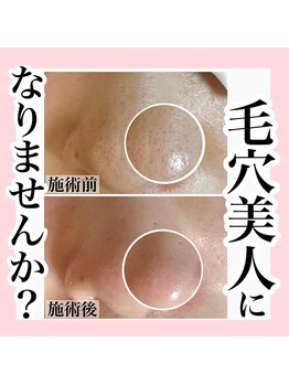 アルムダアクア 天王寺店(Aleumda AQUA)/毛穴エクストラクションプロ大阪