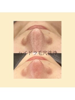 クリーン アンド ビューティー/ハイドラ毛穴洗浄全顔