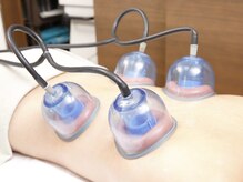 ソフィーム/背中カップ吸引