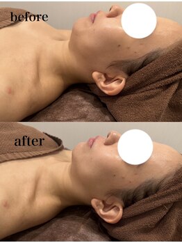 オアシス カナヤマ(Oasis kanayama)/【小顔メニュー】リフトアップ★