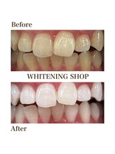 ホワイトニングショップ 函館店(Whitening Shop)/Before &Afterホワイトニング