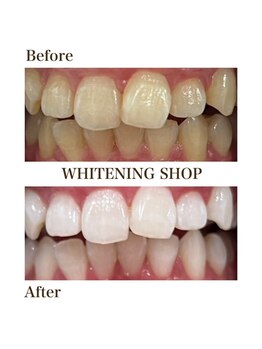 ホワイトニングショップ 函館店(Whitening Shop)/Before &Afterホワイトニング