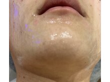 ラブ アンド ピース(Love&Peace)/当店の脱毛は最短期間で無くなる