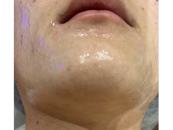 ラブ アンド ピース(Love&Peace)/当店の脱毛は最短期間で無くなる