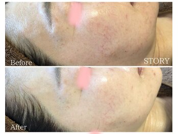 ストーリー 沼津店(STORY)/ハーブピーリング専門店STORY