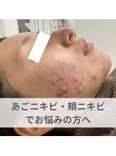 ニキビケア 毛穴研究所 立川店/ほほニキビ・赤ニキビもお任せ！