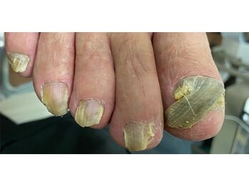 足のトラブルセンター 狸小路店/厚い爪もお任せを
