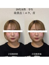 ザ リフト カドモリ 鹿児島 霧島(The Lift KADOMORI)/20代女性/エラ張り