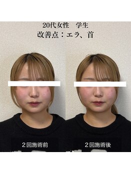 ザ リフト カドモリ 鹿児島 霧島(The Lift KADOMORI)/20代女性/エラ張り