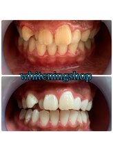 ホワイトニングショップ 池田店/【BEFORE/AFTER】