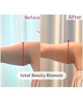 Blossom 【ホワイトニング/脱毛/韓国肌管理/毛穴洗浄】【3/23 NEW OPEN(予定)】/REDSHOT　二の腕