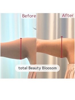 Blossom 【ホワイトニング/脱毛/韓国肌管理/毛穴洗浄】【3/23 NEW OPEN(予定)】/REDSHOT　二の腕