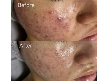 サロン ウルハ(Salon Uruha)/ニキビケア【マイクロニードル】