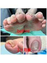 アーク/B/Sブレイス　巻爪緩和ケア