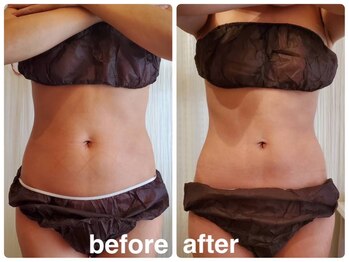 エステサロン キュート(Cute)/Wマシン×ハイパーナイフ上半身