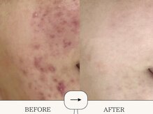 ハイフン(HIFUN)/最強ローズドメーラ（剥離◎）