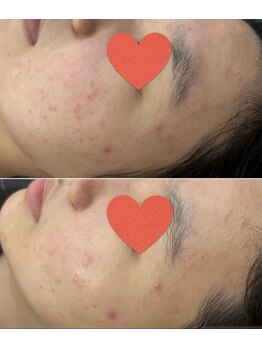 ビオラ(美ola)/ダクトピールでニキビ肌を艶肌へ