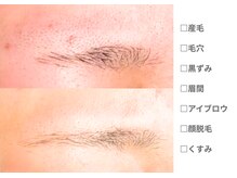 ピュアノア 垂水店/産毛脱毛　顔脱毛　神戸垂水明石