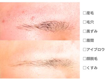 ピュアノア 垂水店/産毛脱毛　顔脱毛　神戸垂水明石