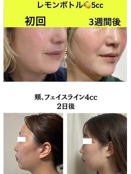 グラシーズ(Glasses)/脂肪分解で二重あごもスッキリ◎