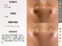 ルディラ 恵比寿店/ハイドラフェイシャル