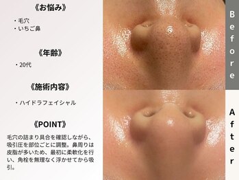 ルディラ 恵比寿店/ハイドラフェイシャル