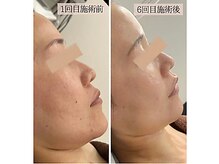 リノン(LINON)/ハーブピーリング &nbsp;施術回６数回