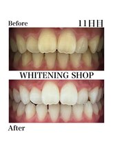 ホワイトニングショップ 豊橋店(WHITENING SHOP)/Before&After　11日目のお客様