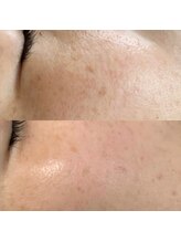 エースビューティー(Ace.Beauty)/