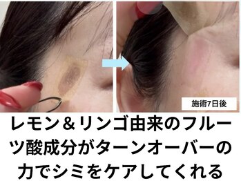 ビープラス(Biplus)/韓国で話題の肌管理シミケア