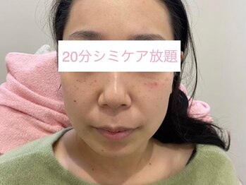 サクラ 伊勢原店(SAKURA)/肌質改善は美容版微細針