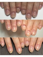 サンマルイチ(301)/自爪育成／クリア／トラブル爪